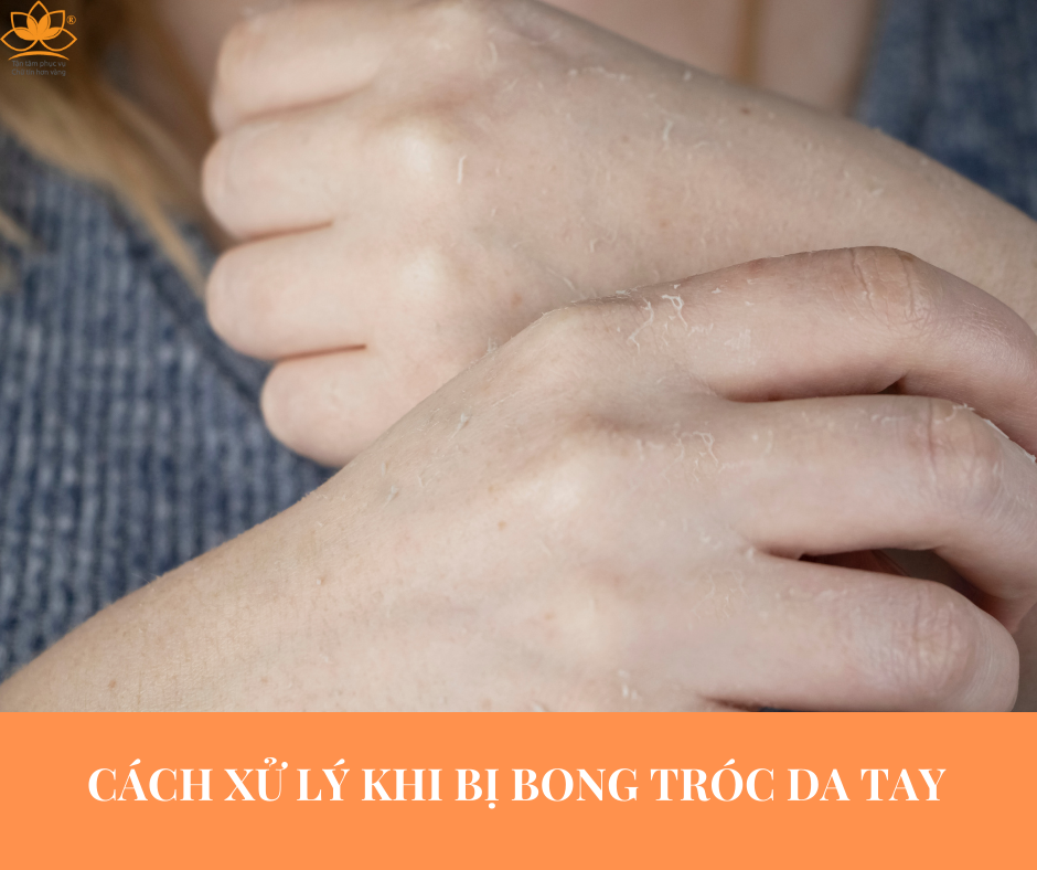 CÁCH XỬ LÝ TRÓC DA TAY